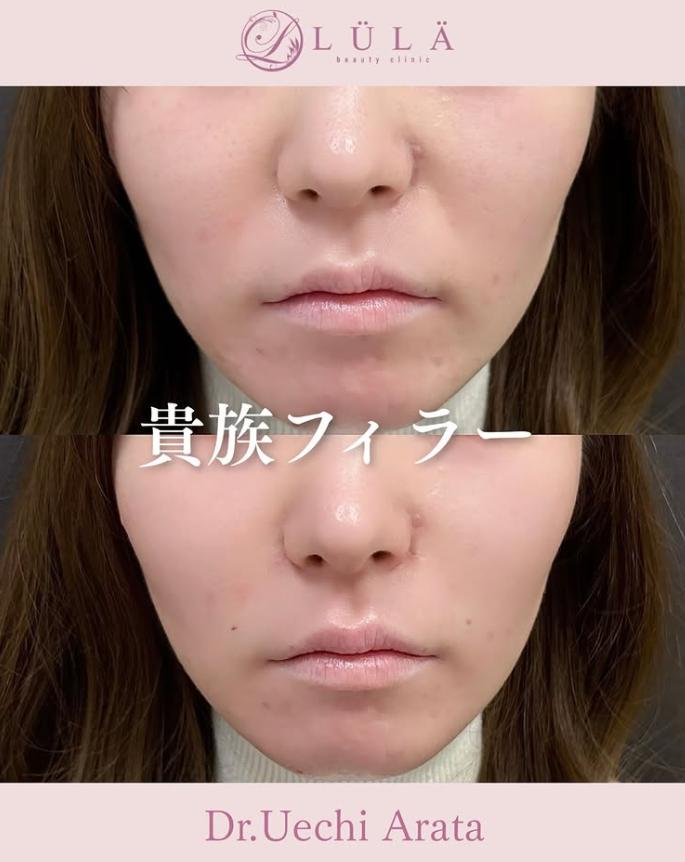 ヒアルロン酸の症例写真