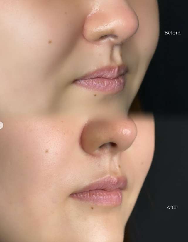 ヒアルロン酸の症例写真