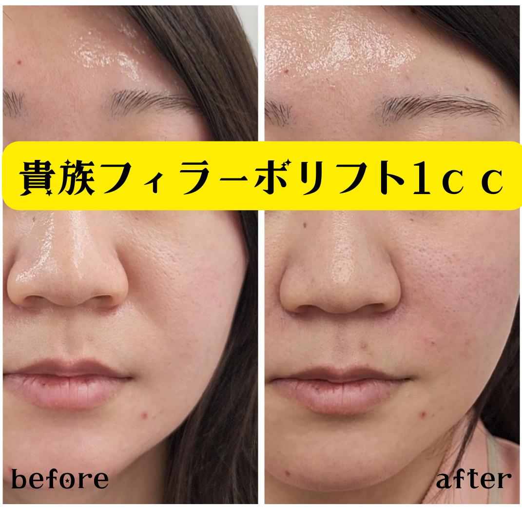 ヒアルロン酸の症例写真