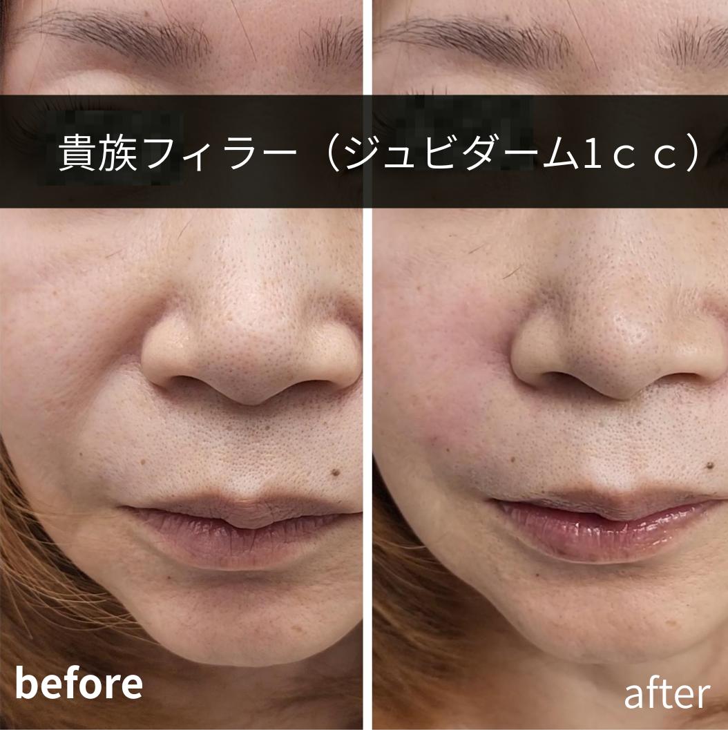 ヒアルロン酸の症例写真