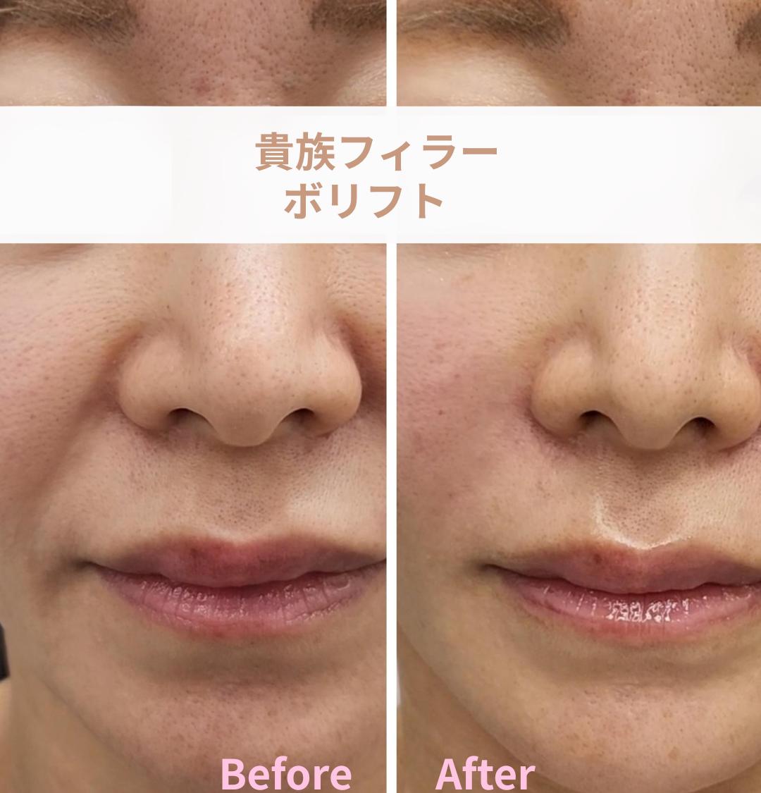 ヒアルロン酸の症例写真
