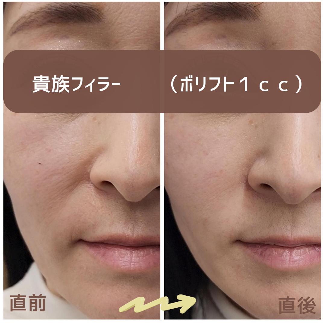 ヒアルロン酸の症例写真