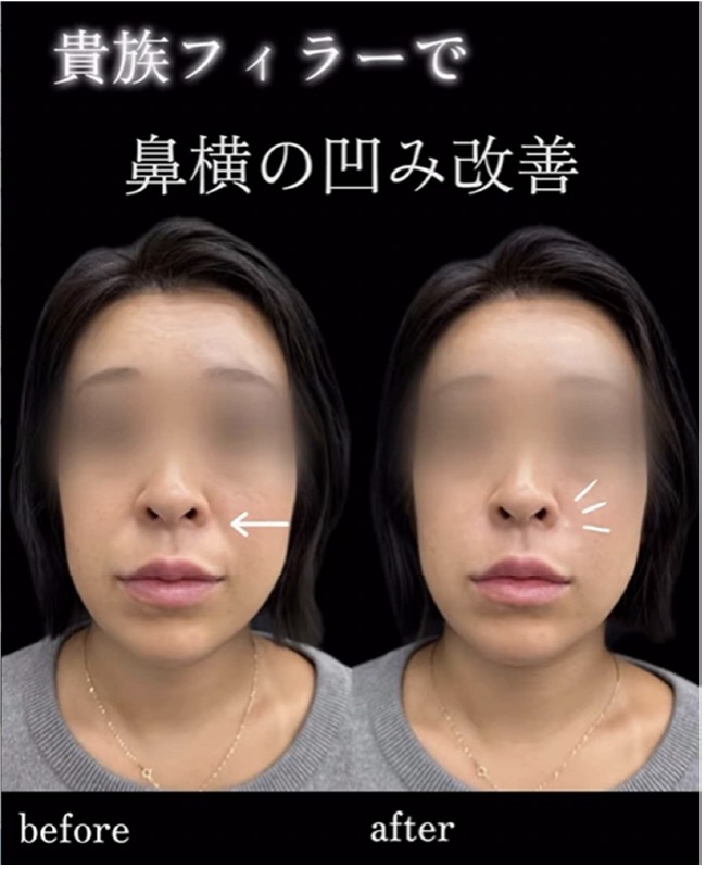 ヒアルロン酸の症例写真