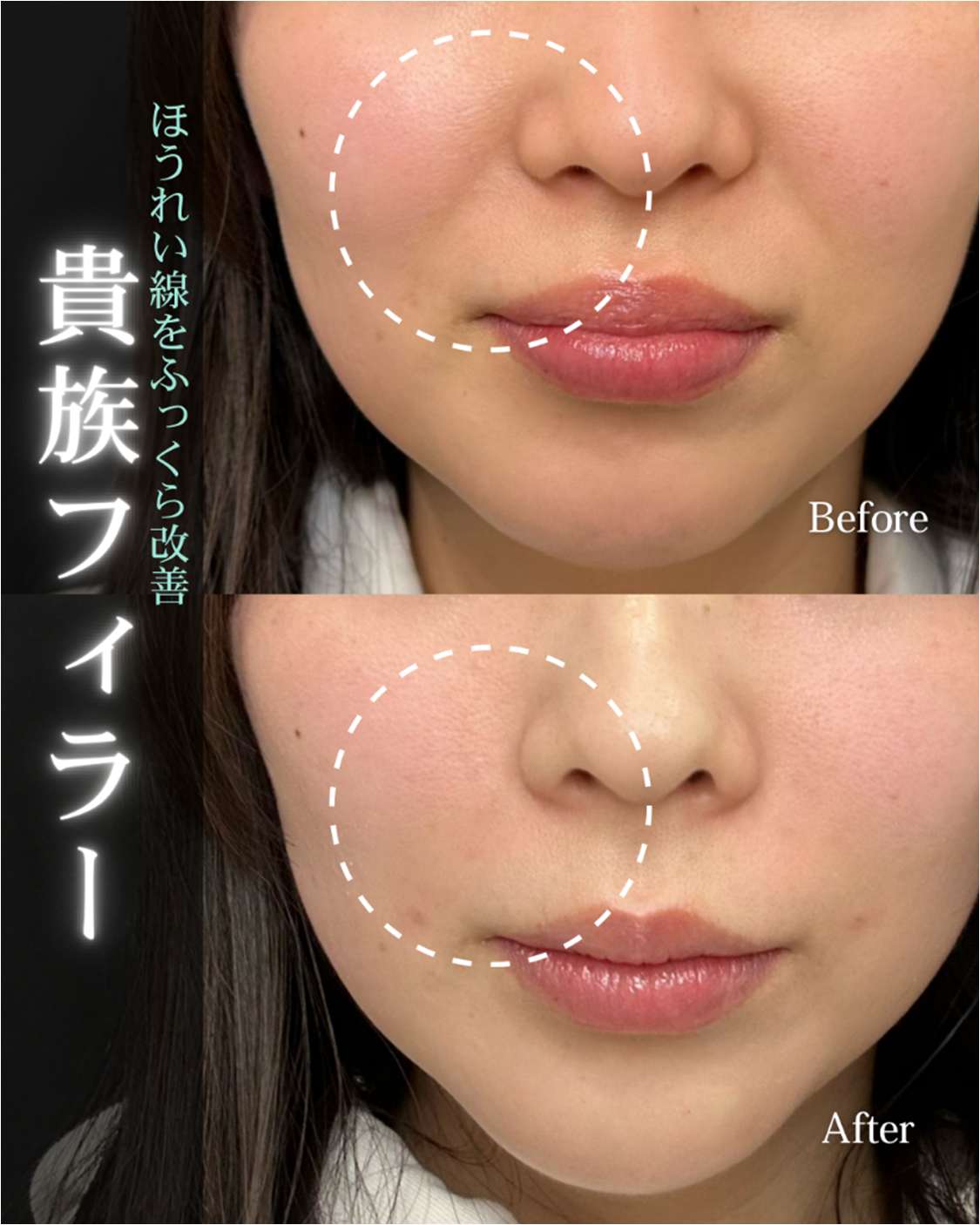 ヒアルロン酸の症例写真