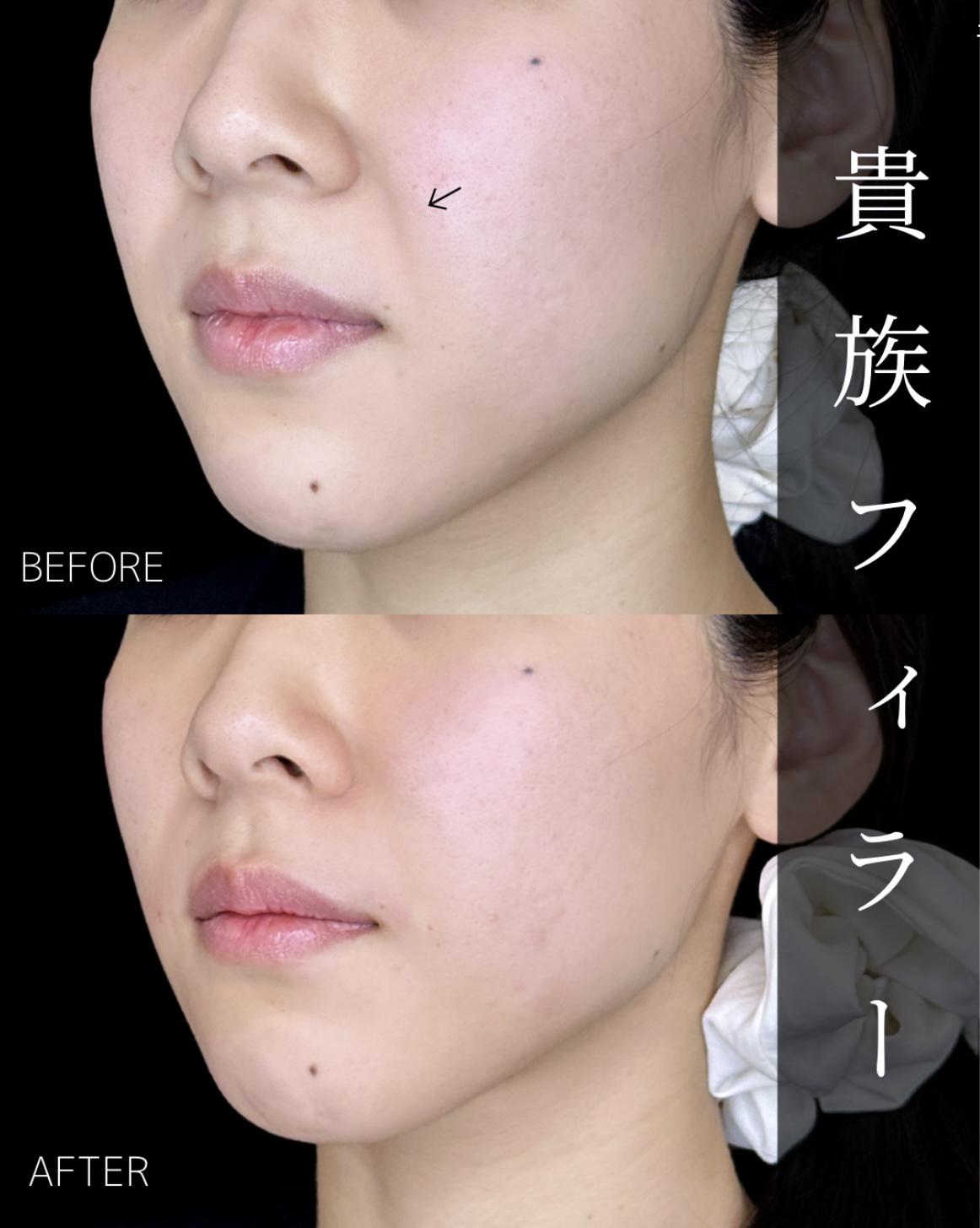 ヒアルロン酸の症例写真