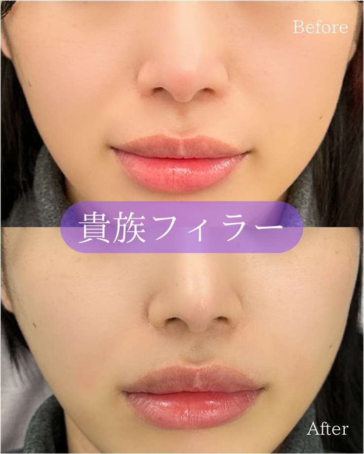 ヒアルロン酸の症例写真