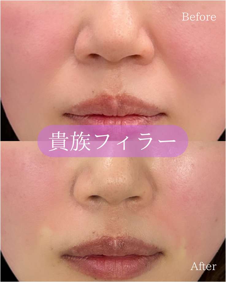 ヒアルロン酸の症例写真