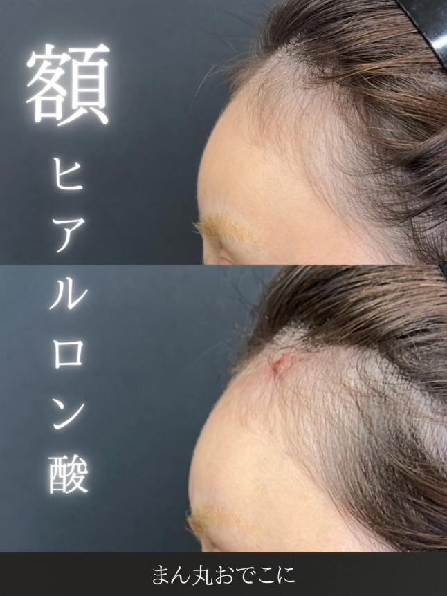 ヒアルロン酸の症例写真