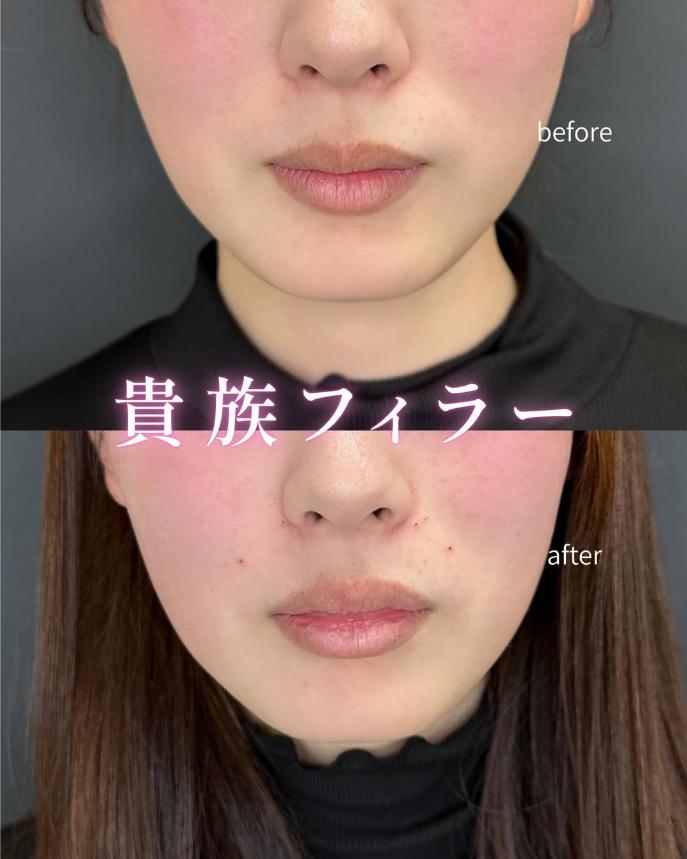 ヒアルロン酸の症例写真