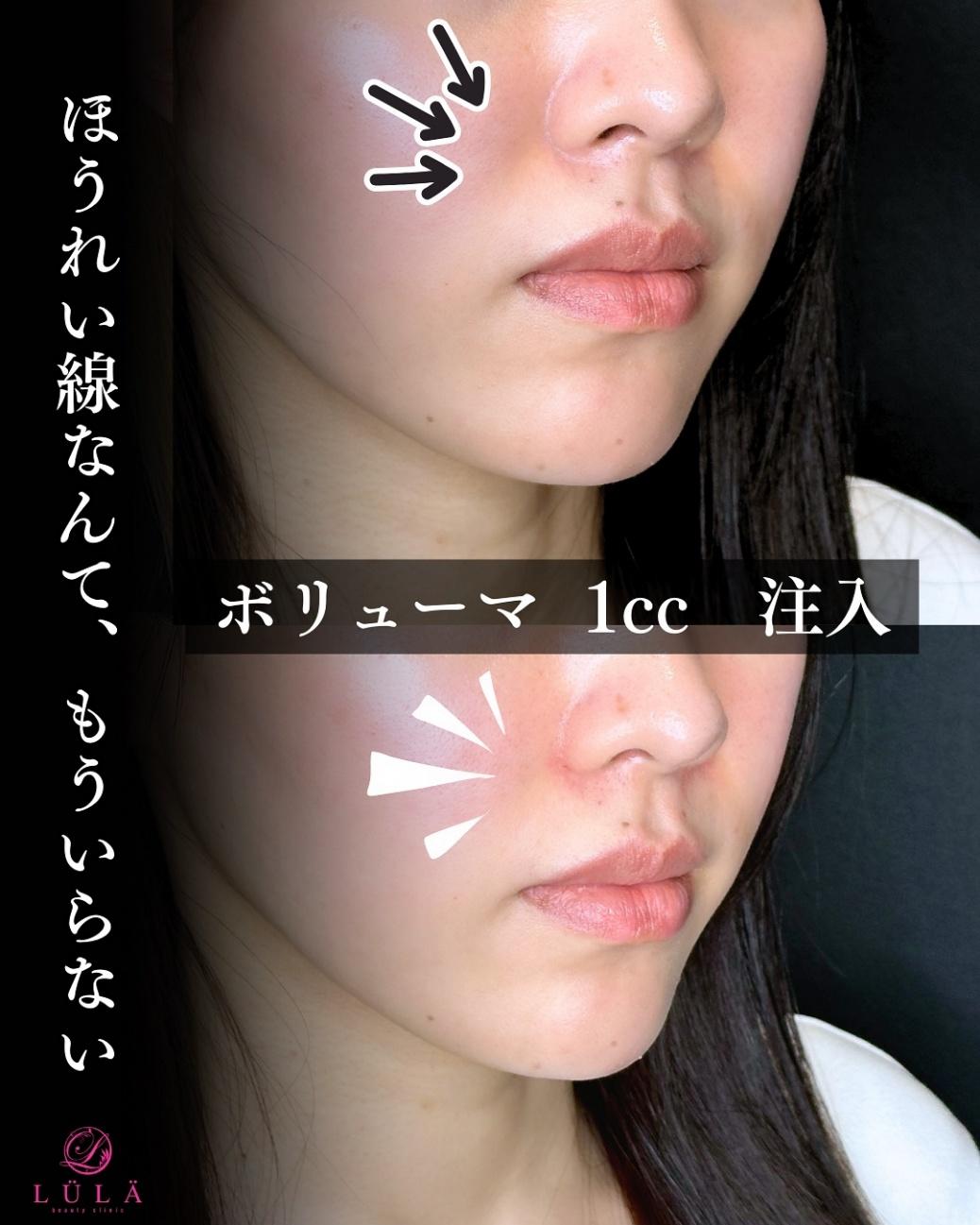 ヒアルロン酸の症例写真