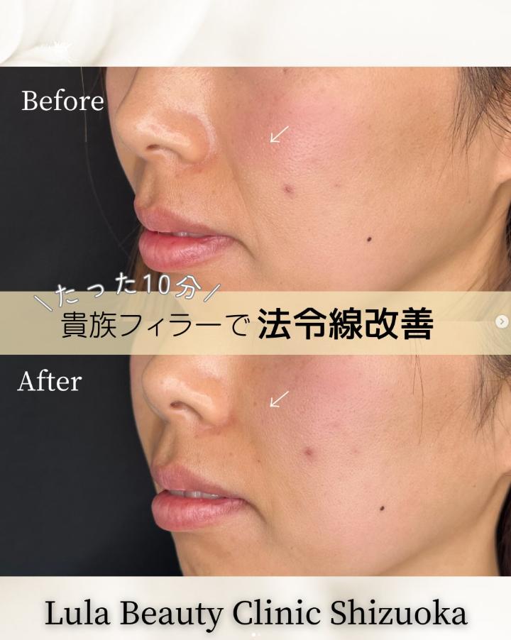 ヒアルロン酸の症例写真