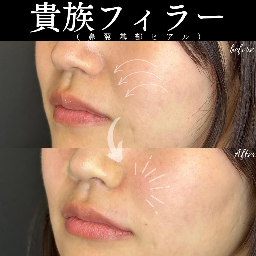 ヒアルロン酸の症例写真