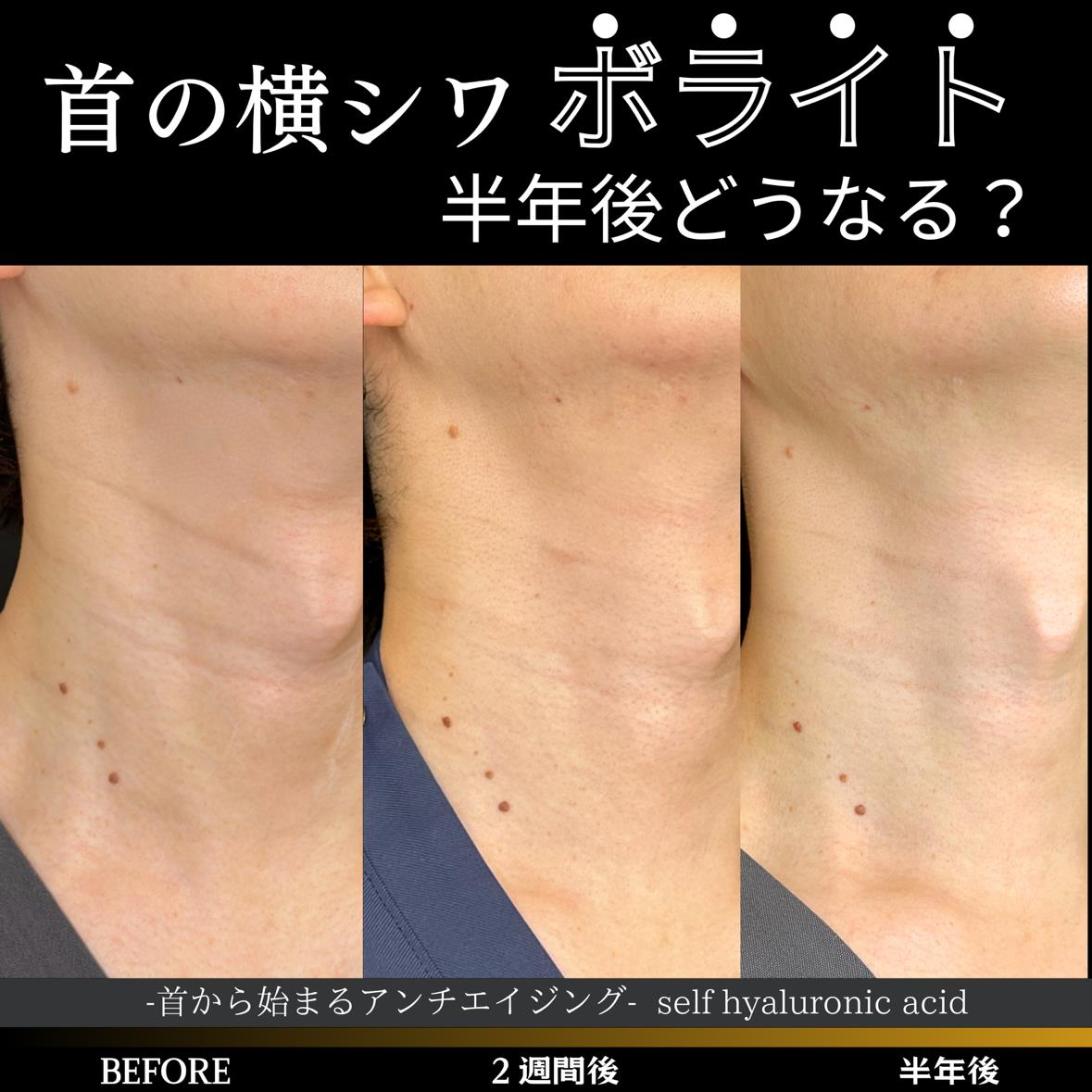 ヒアルロン酸の症例写真