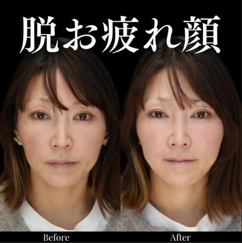 ヒアルロン酸の症例写真