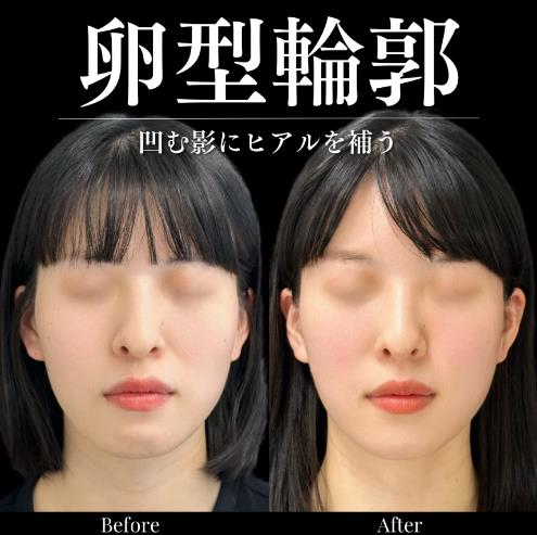 ヒアルロン酸の症例写真