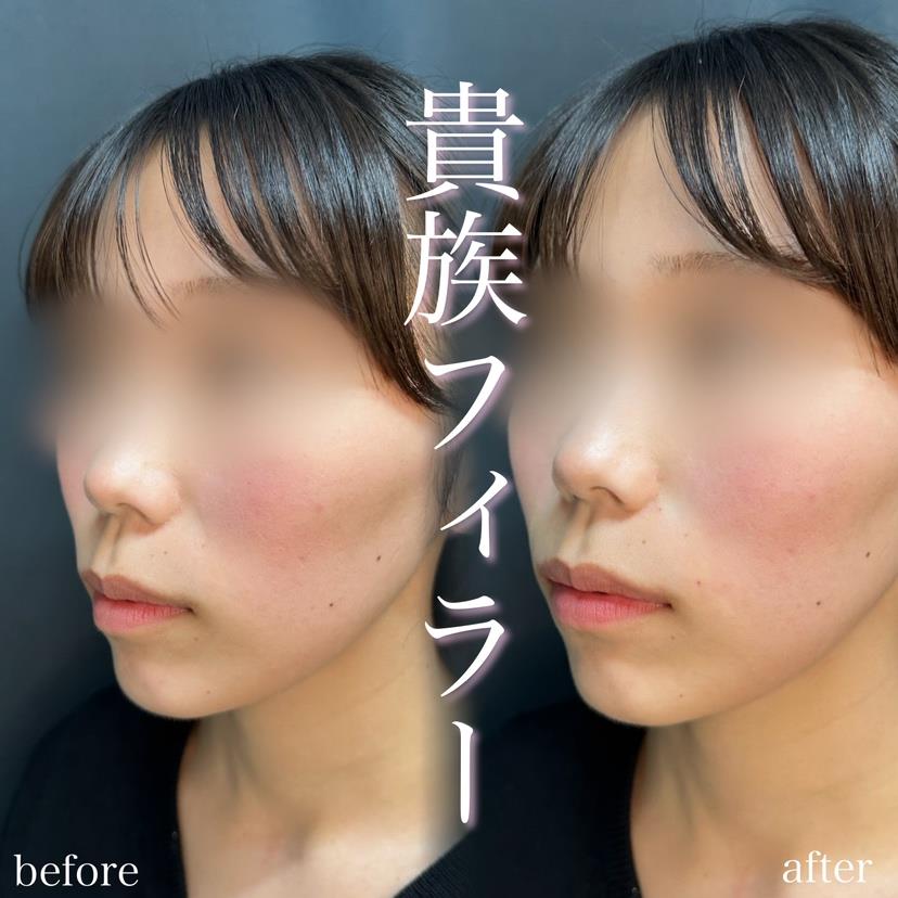 ヒアルロン酸の症例写真