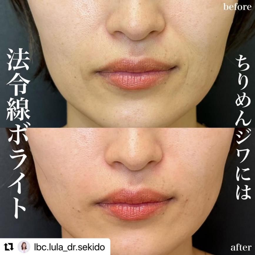 ヒアルロン酸の症例写真