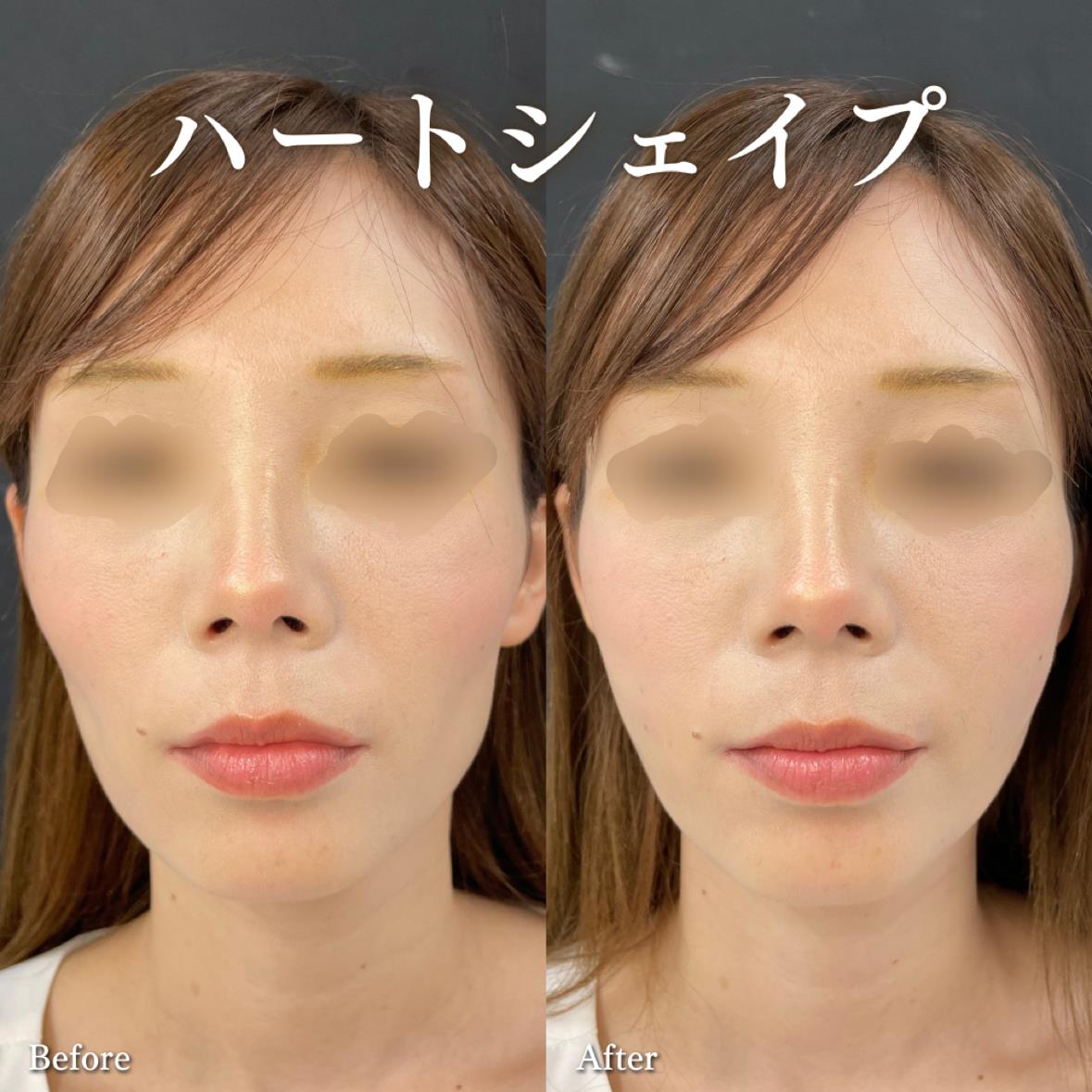 ヒアルロン酸の症例写真