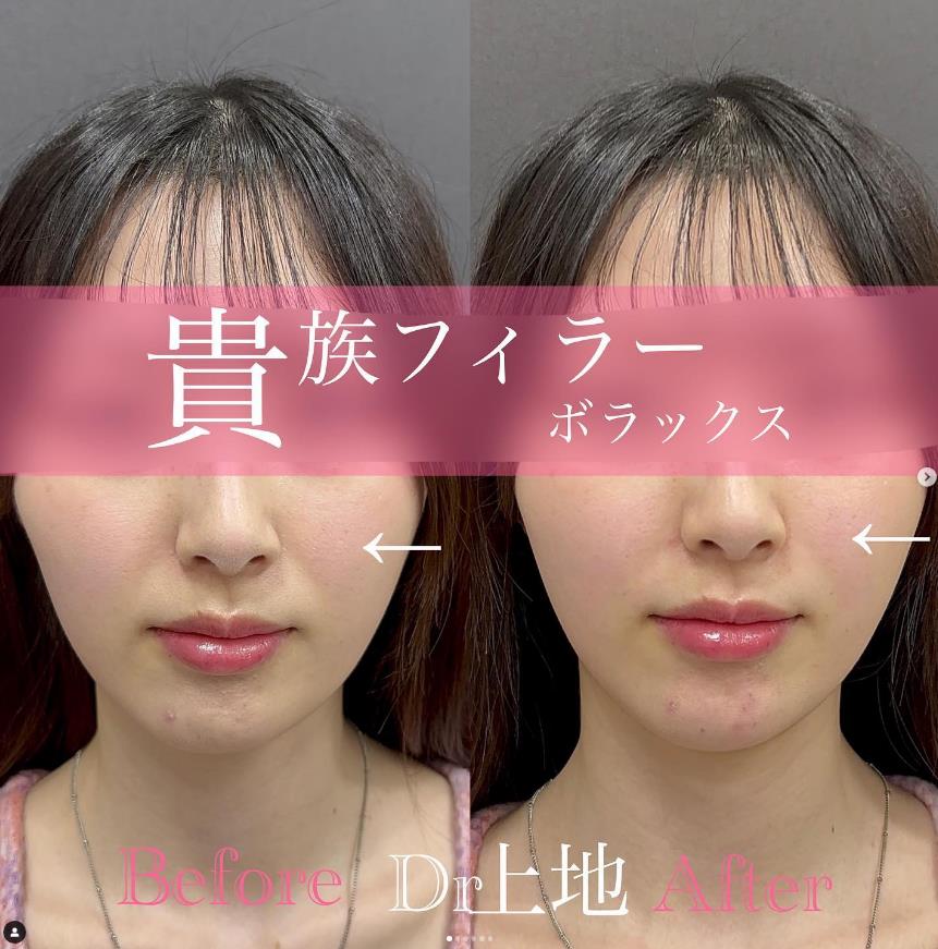 ヒアルロン酸の症例写真