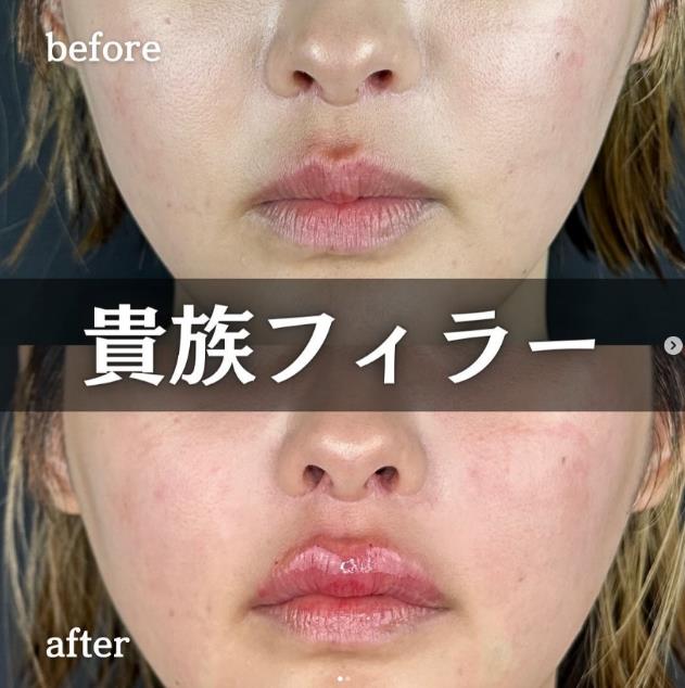 ヒアルロン酸の症例写真