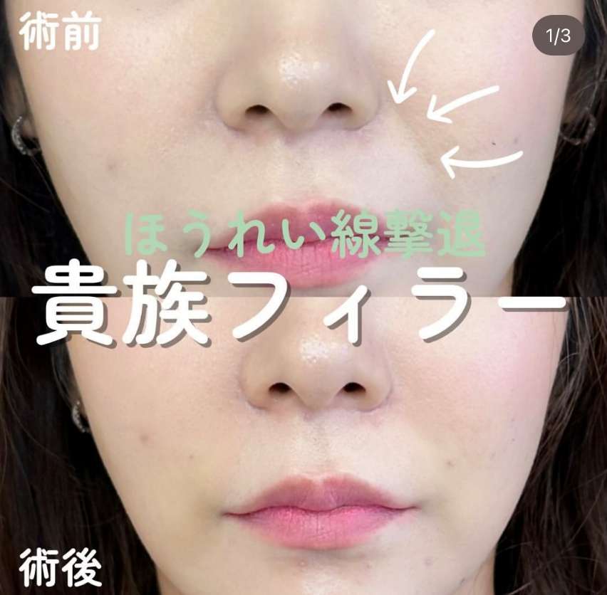 ヒアルロン酸の症例写真