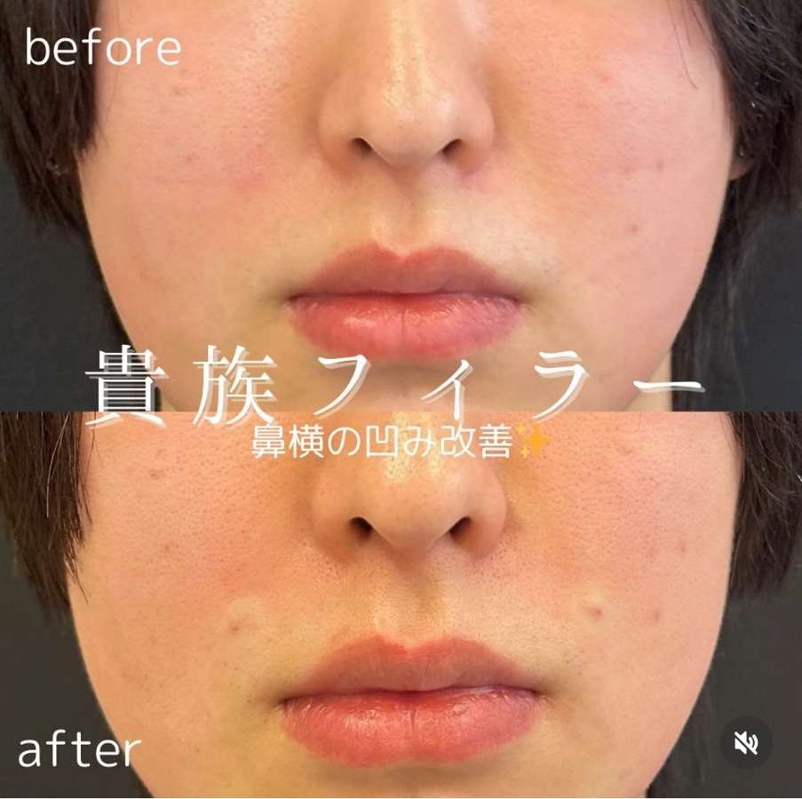ヒアルロン酸の症例写真