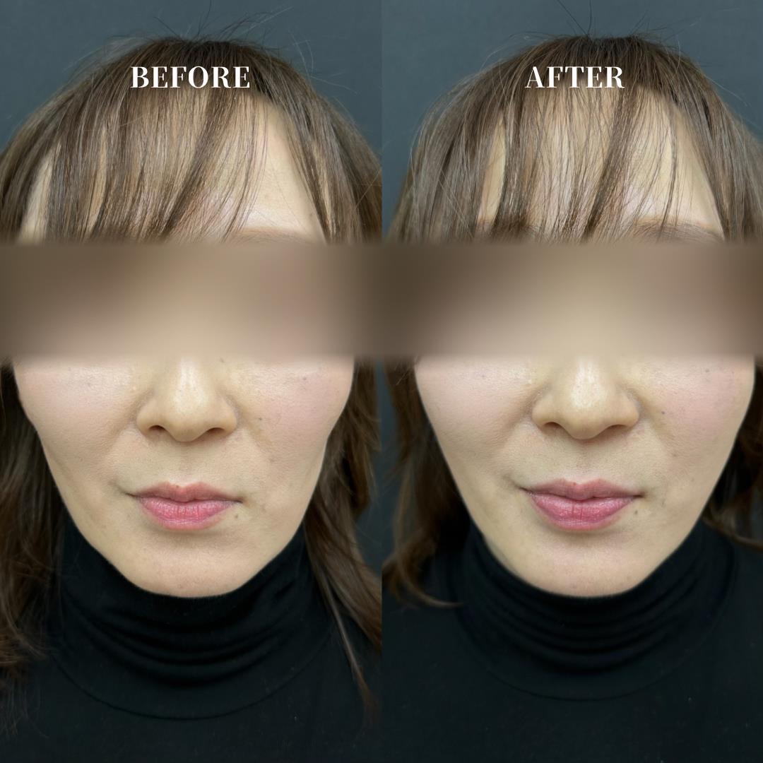 ヒアルロン酸の症例写真