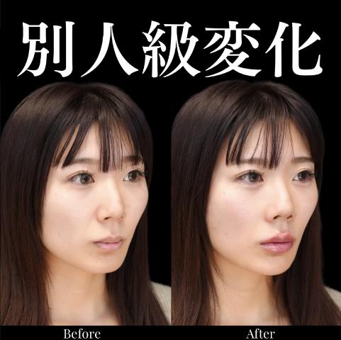 ヒアルロン酸の症例写真