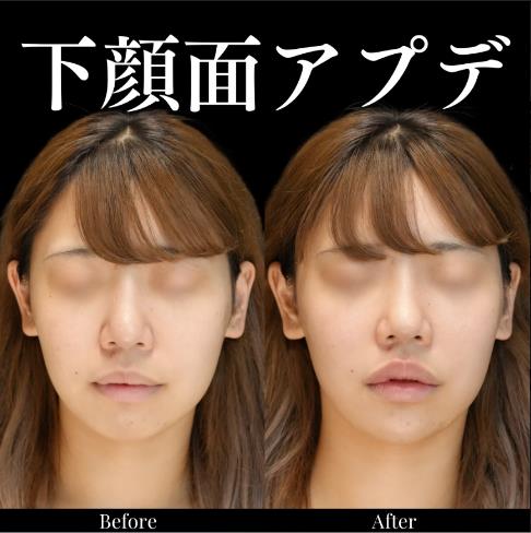 ヒアルロン酸の症例写真