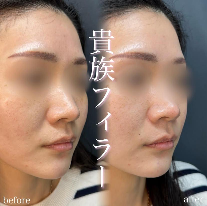 ヒアルロン酸の症例写真