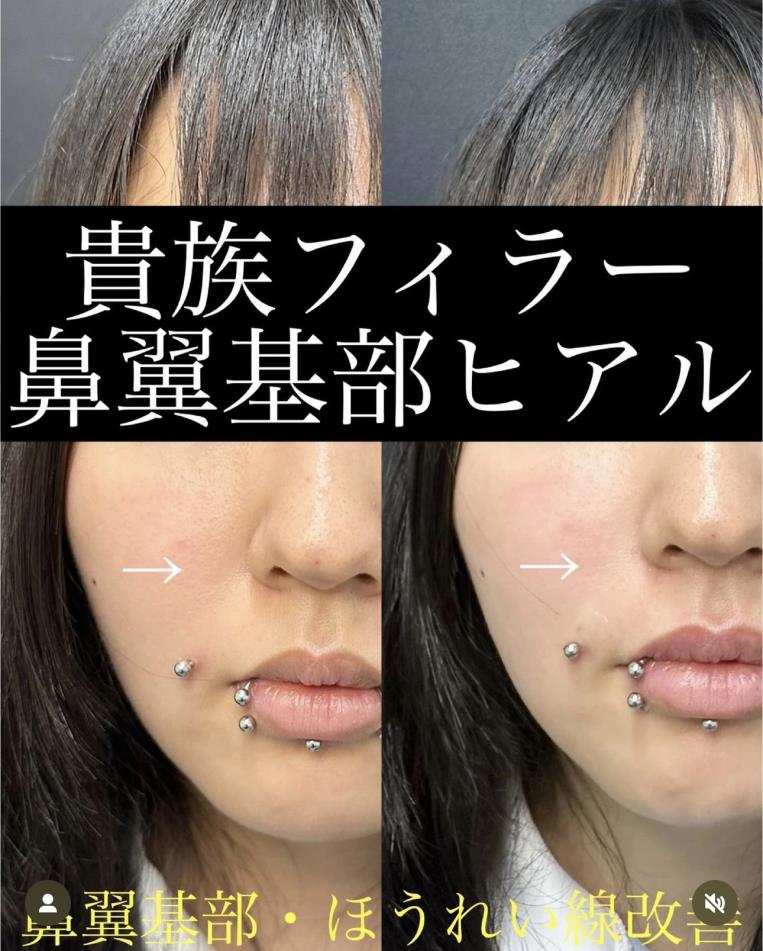 ヒアルロン酸の症例写真