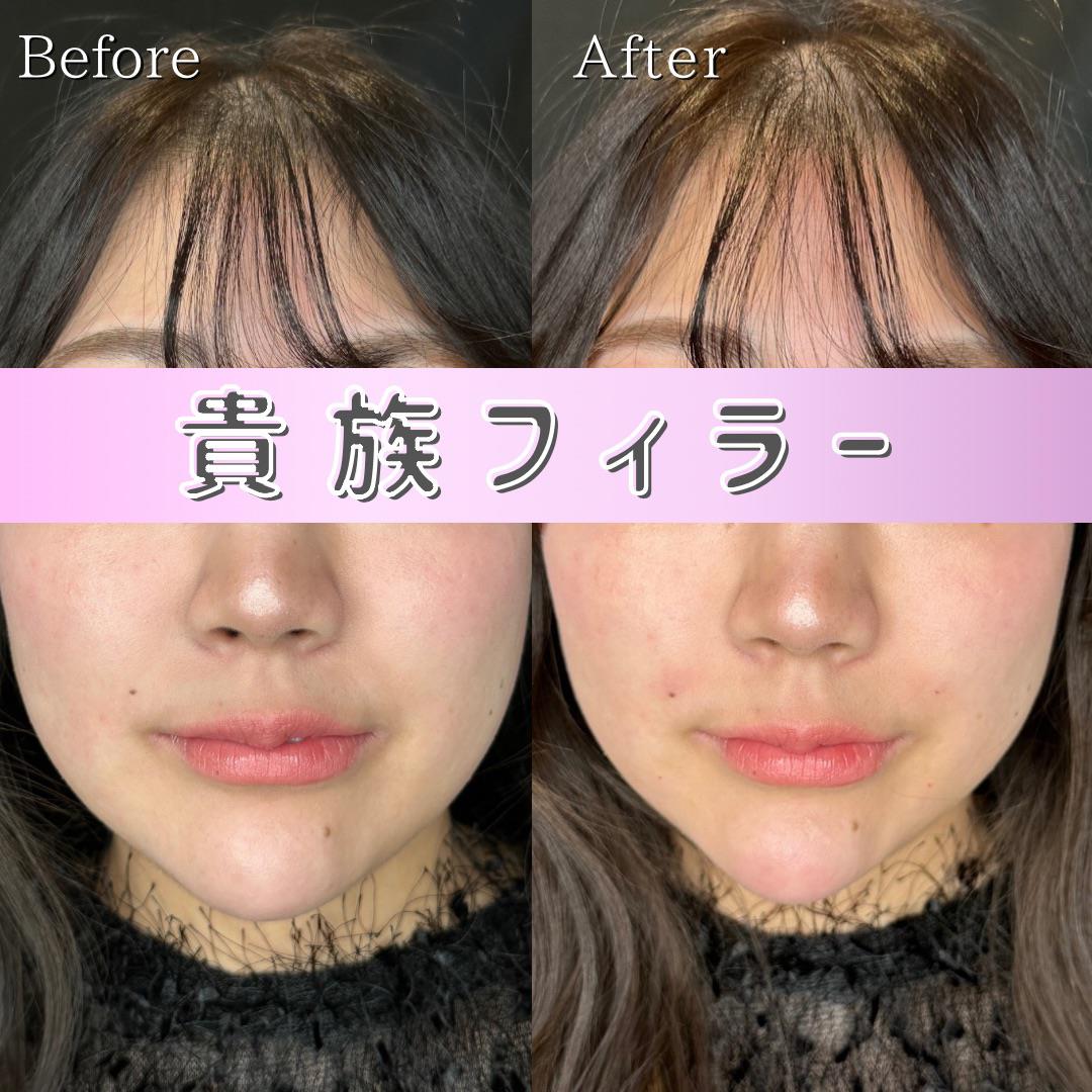 ヒアルロン酸の症例写真