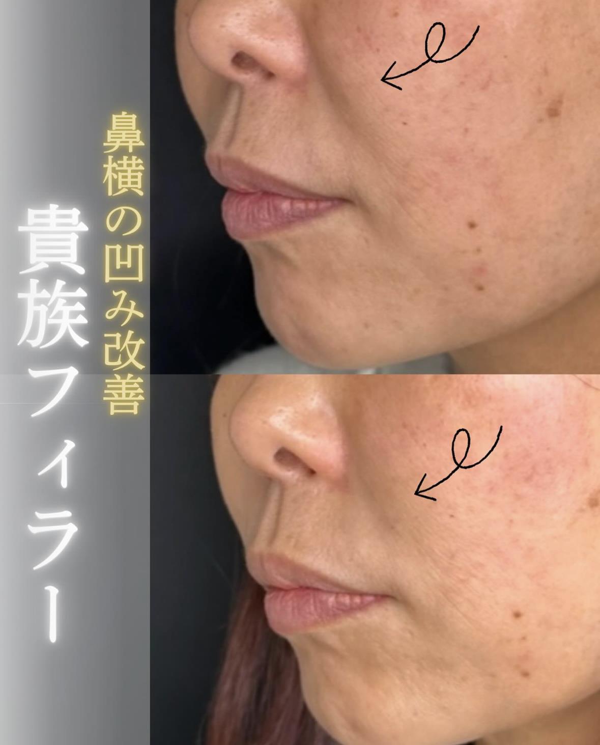 ヒアルロン酸の症例写真