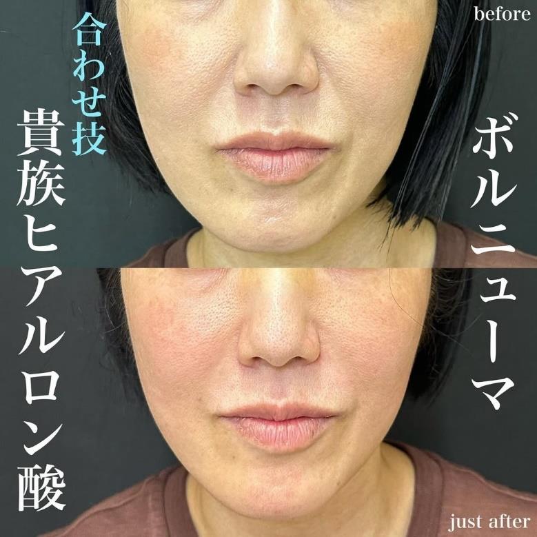 ヒアルロン酸の症例写真