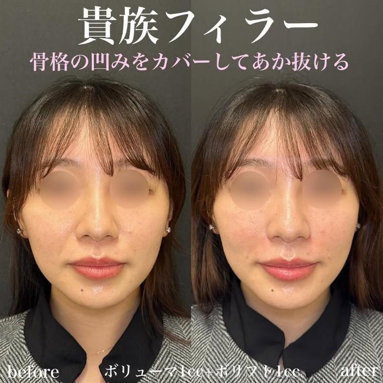 ヒアルロン酸の症例写真