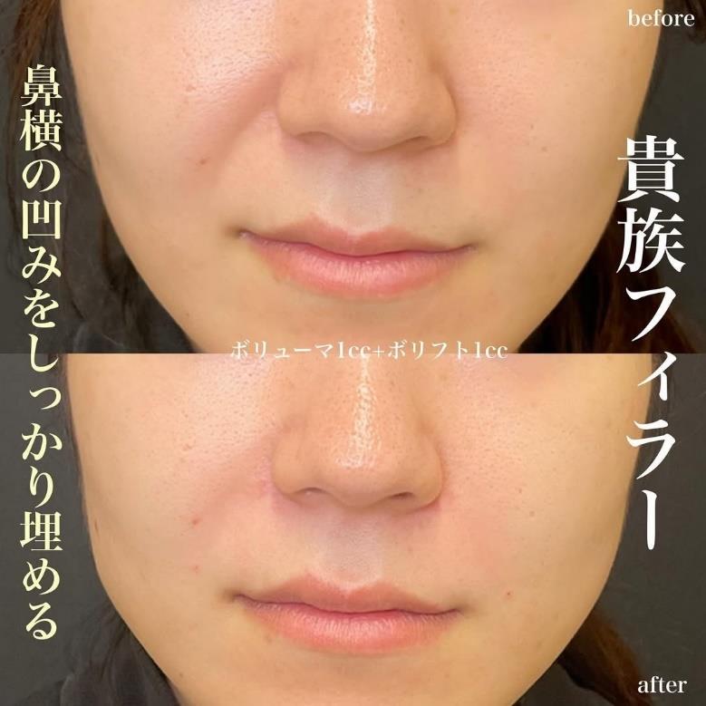 ヒアルロン酸の症例写真