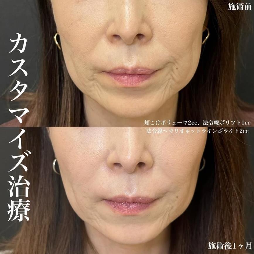 ヒアルロン酸の症例写真
