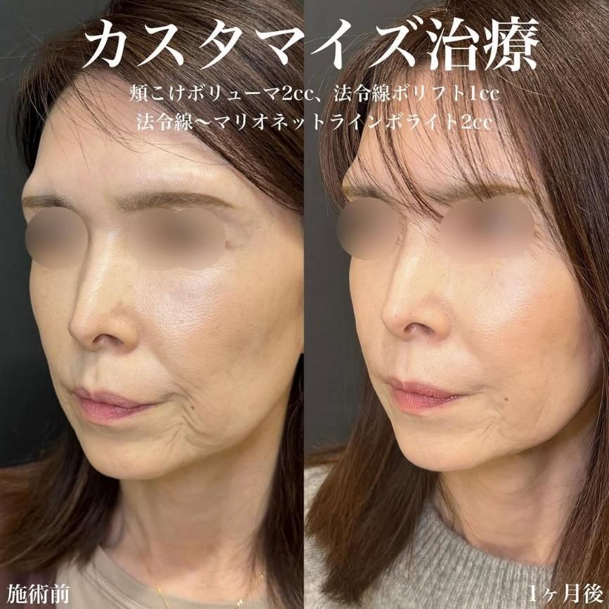 ヒアルロン酸の症例写真