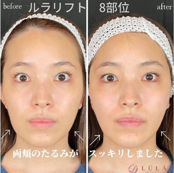 糸リフト（ルラリフト）の症例写真
