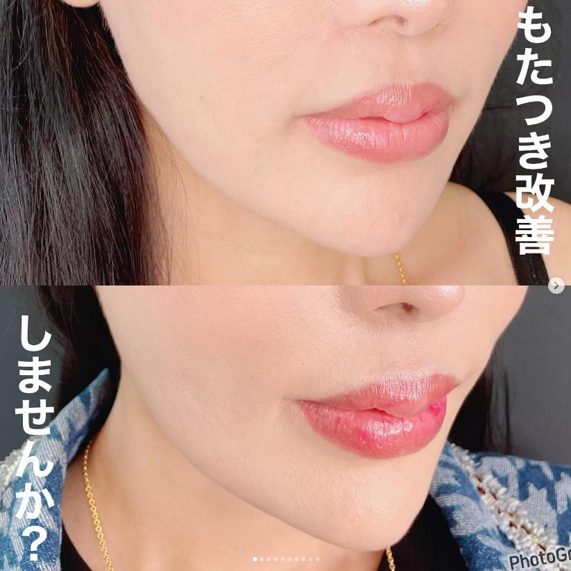 ルラリフトの症例写真