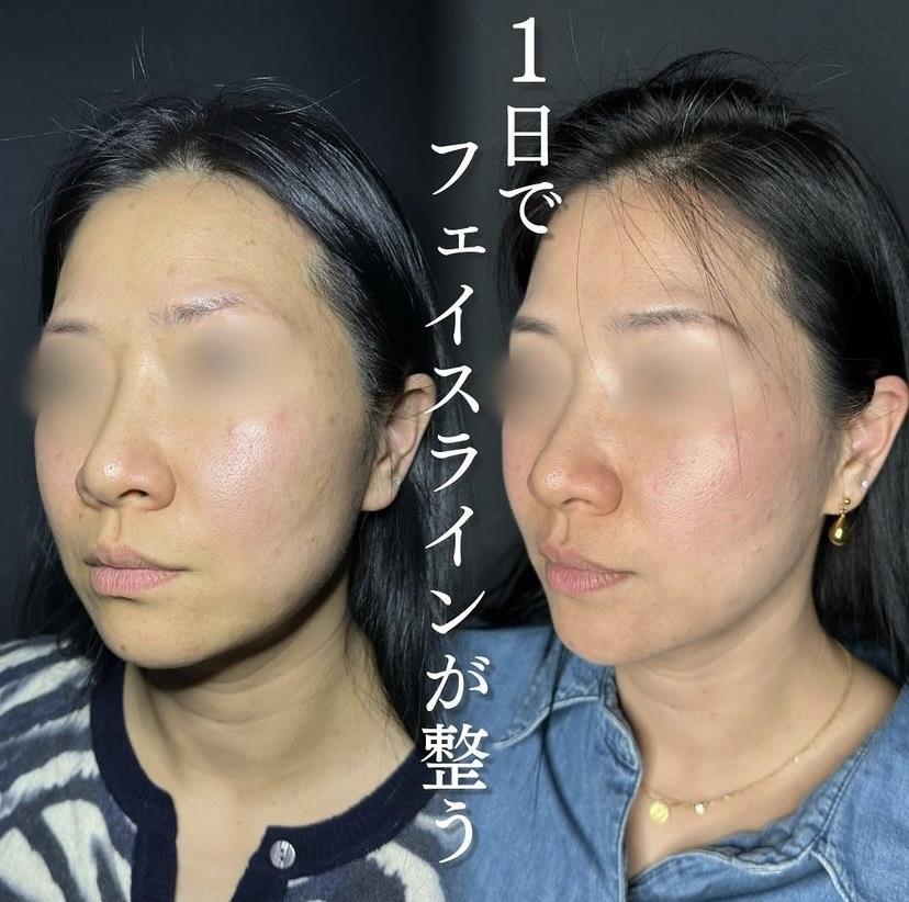 ルラリフトの症例写真