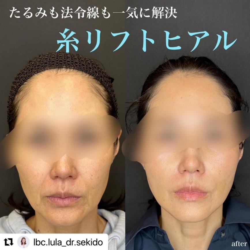 ルラリフトの症例写真