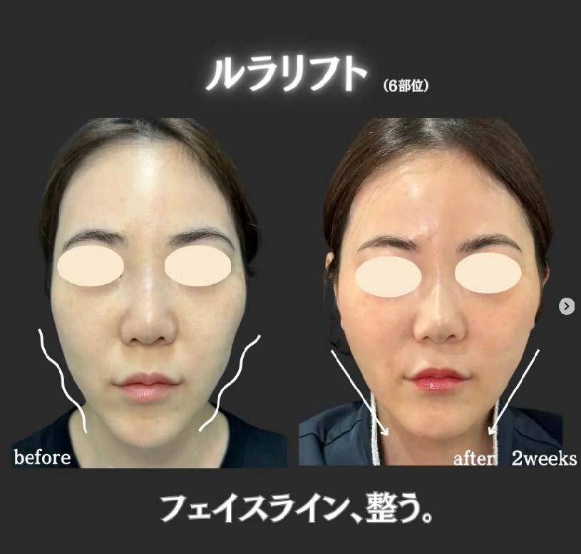 ルラリフトの症例写真