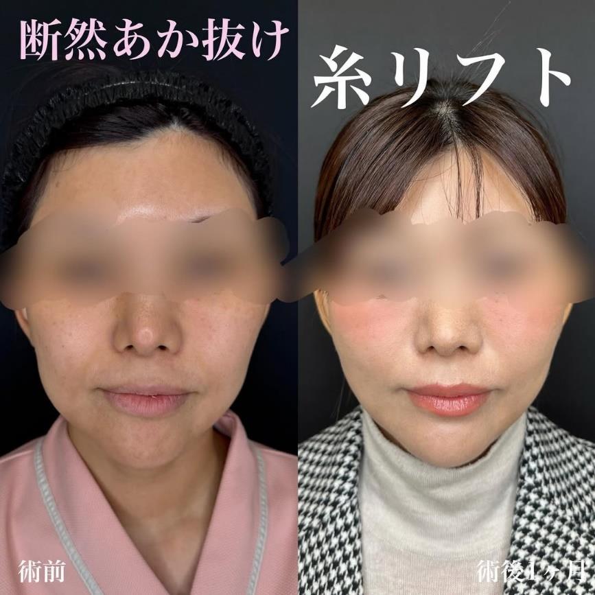 ルラリフトの症例写真