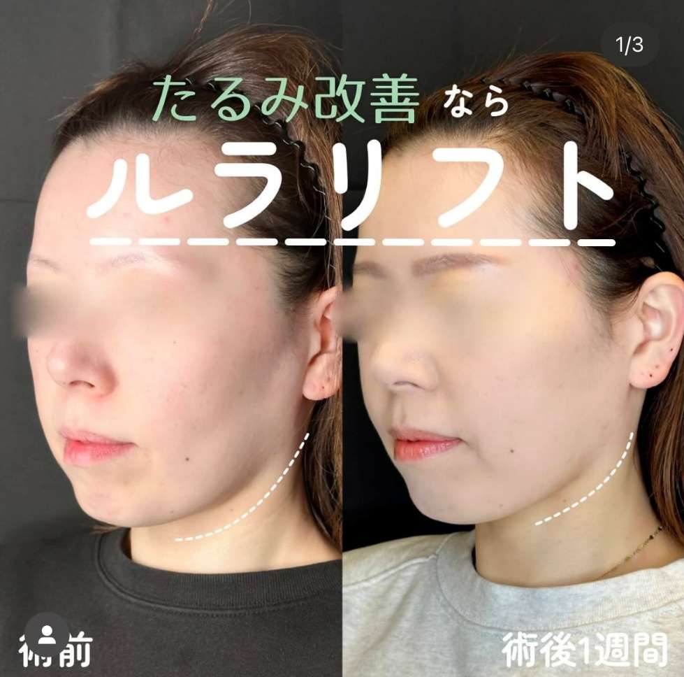 ルラリフトの症例写真