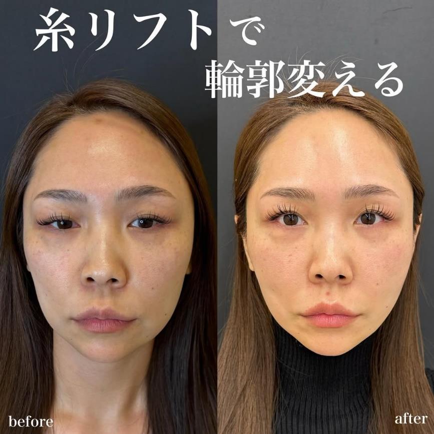 ルラリフトの症例写真