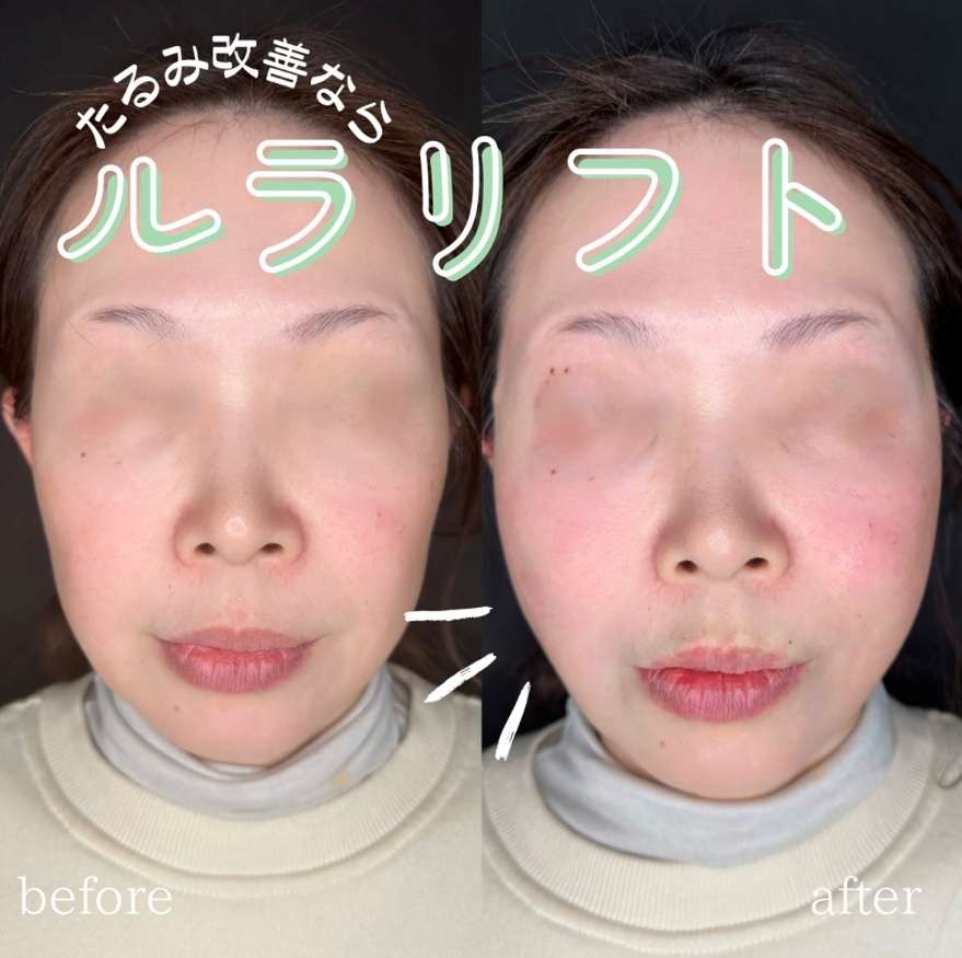 ルラリフトの症例写真