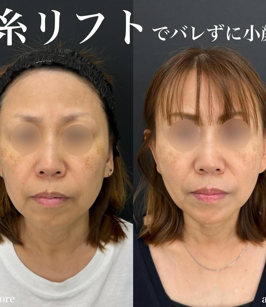 ルラリフトの症例写真