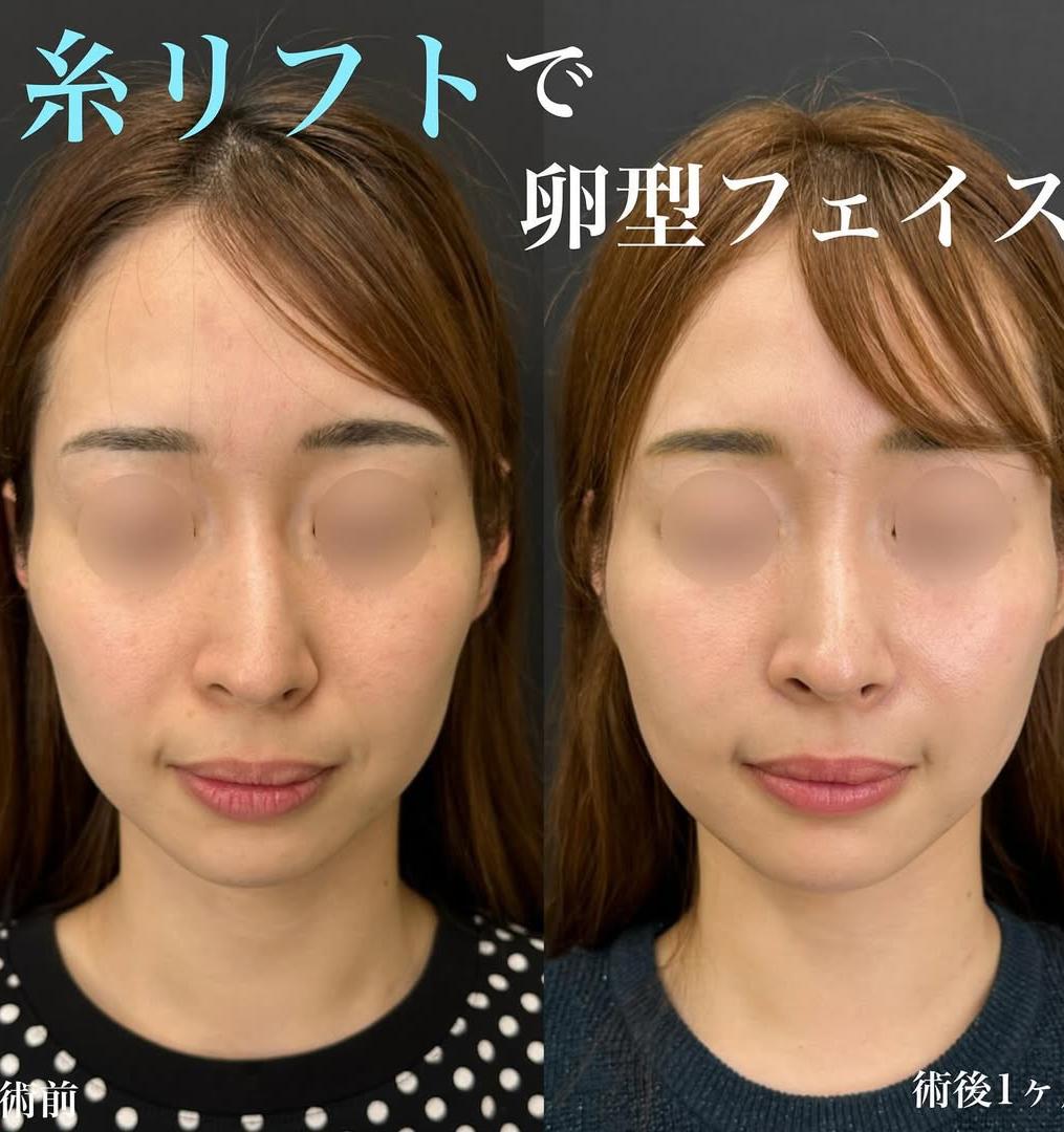 ルラリフトの症例写真