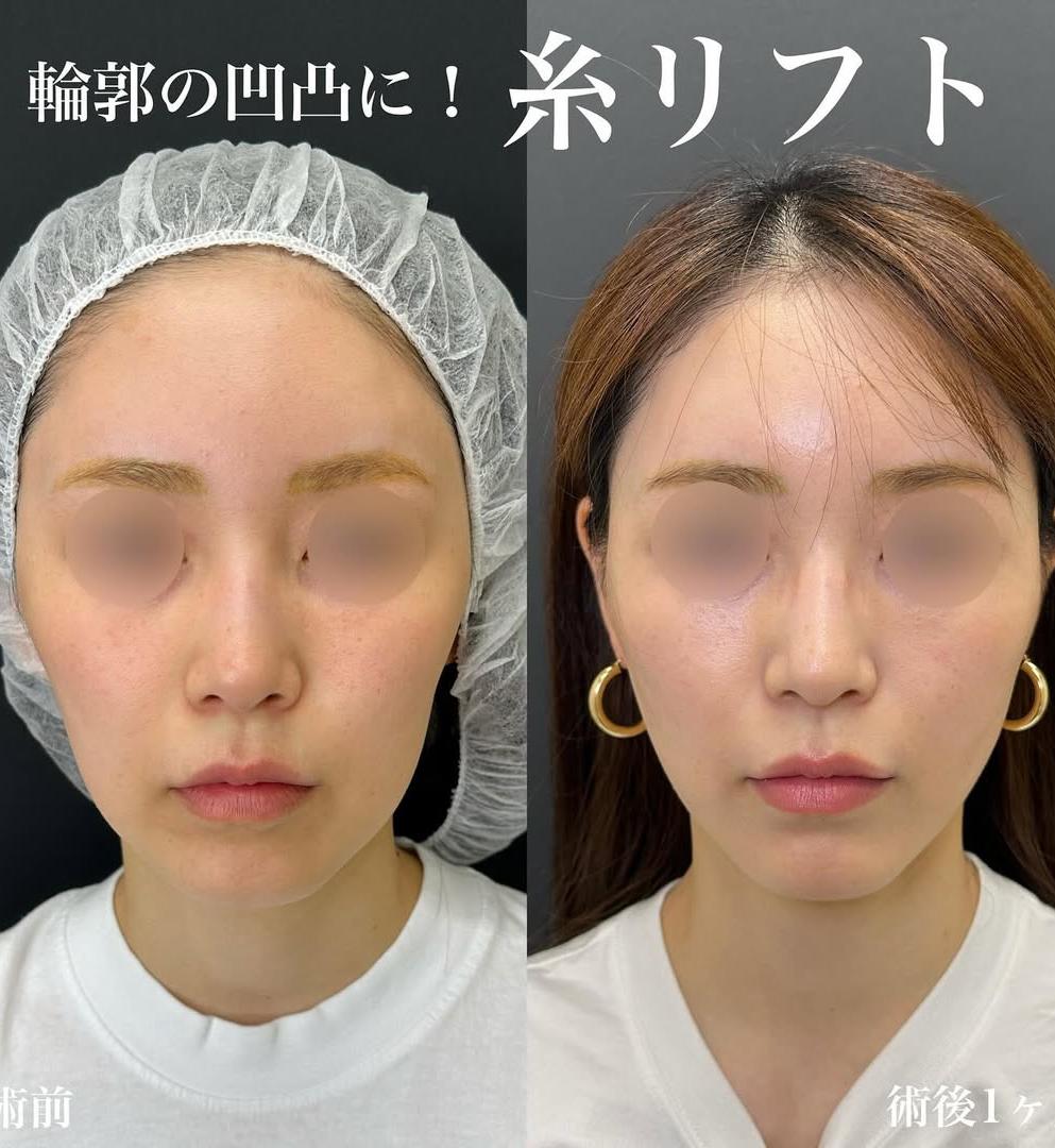 ルラリフトの症例写真